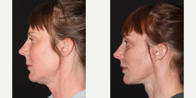 Neck Lift before and after photo