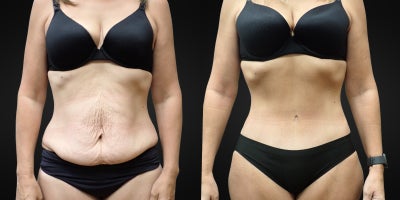 Tummy Tuck before and after photo
