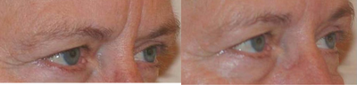 Botox before and after photo