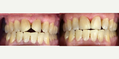 Dental Bonding before and after photo