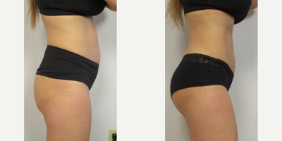 Emsculpt before and after photo