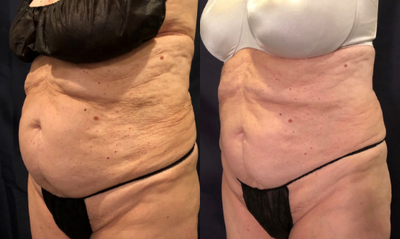 SculpSure before and after photo