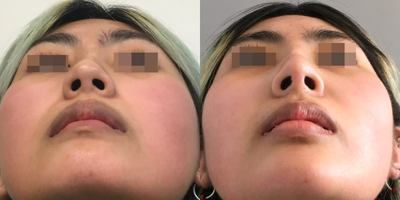 Asian Rhinoplasty before and after photo