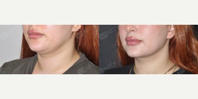 Chin Liposuction before and after photo