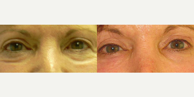 Eyelid Surgery before and after photo