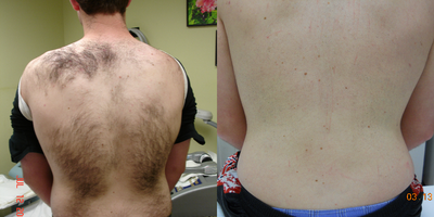 Laser Hair Removal before and after photo