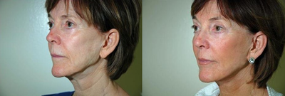 Mini Facelift before and after photo