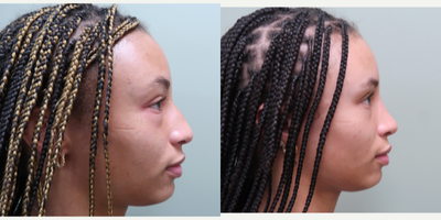 Rhinoplasty before and after photo