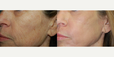 Skin Rejuvenation before and after photo