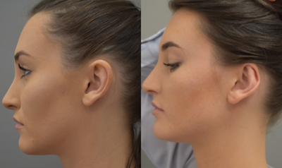 Ear Surgery before and after photo