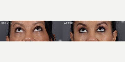 Eyelid Surgery before and after photo