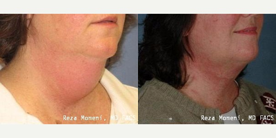 Facelift before and after photo