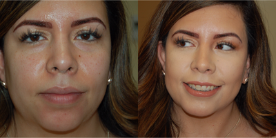 Juvederm before and after photo