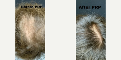 PRP for Hair Loss before and after photo