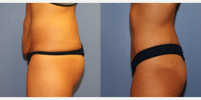 Tummy Tuck before and after photo