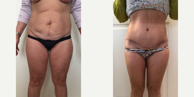 Tummy Tuck before and after photo