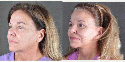 Facelift before and after photo
