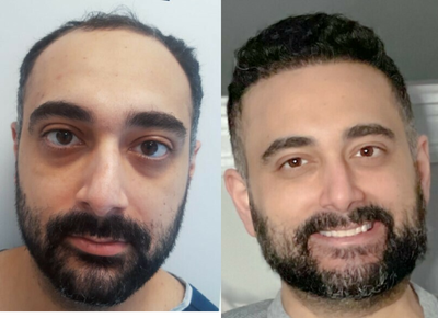 Hair Loss Treatment before and after photo