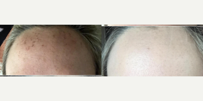Laser Resurfacing before and after photo