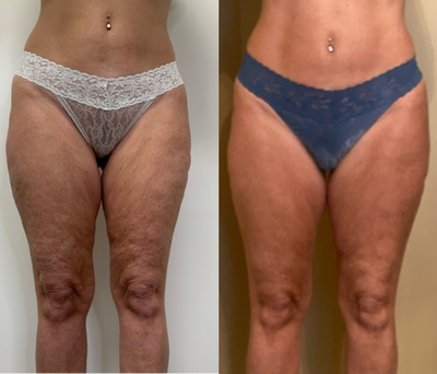 Profound RF before and after photo