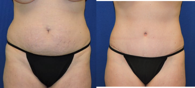 Tummy Tuck before and after photo