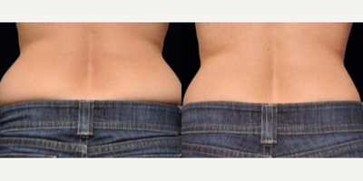 CoolSculpting before and after photo