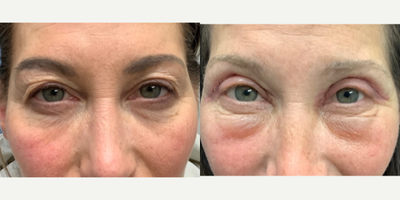 Eyelid Surgery before and after photo