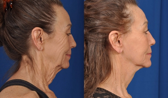 Facelift before and after photo