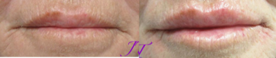 Juvederm before and after photo