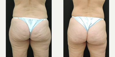 Smart Lipo before and after photo
