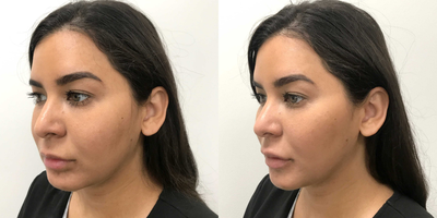 Juvederm before and after photo
