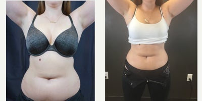 SculpSure before and after photo