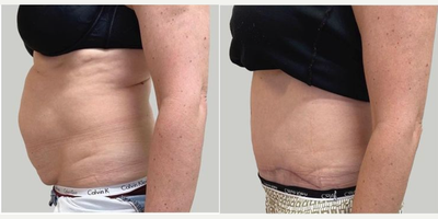 Tummy Tuck before and after photo