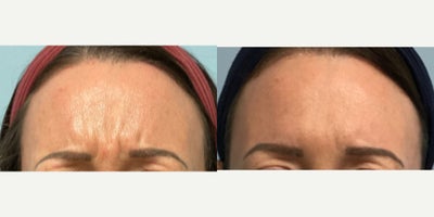 Botox before and after photo