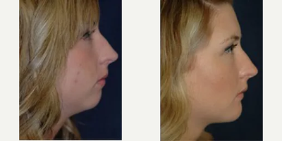 Chin Implant before and after photo