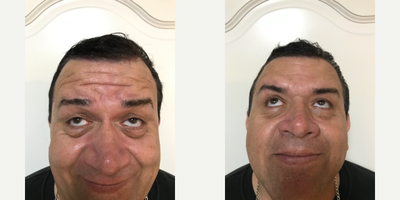 Dysport before and after photo