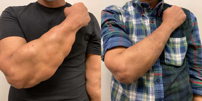 Lipoma Removal before and after photo