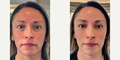 Microneedling before and after photo