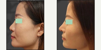 Rhinoplasty before and after photo