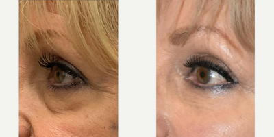 Eyelid Surgery before and after photo