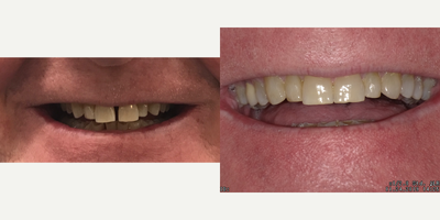 Invisalign before and after photo