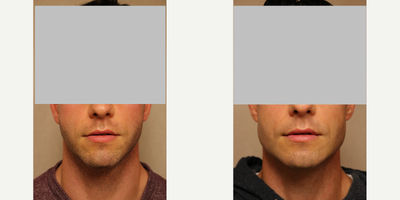 Jaw Surgery before and after photo
