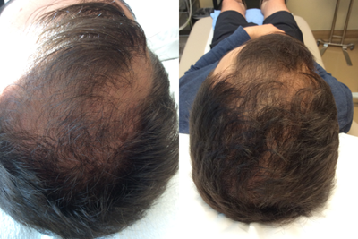 PRP for Hair Loss before and after photo