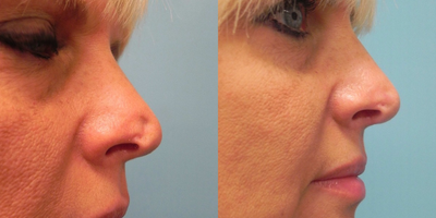 Rhinoplasty before and after photo