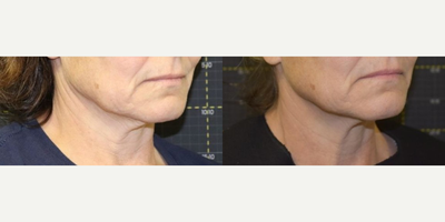 Sofwave before and after photo
