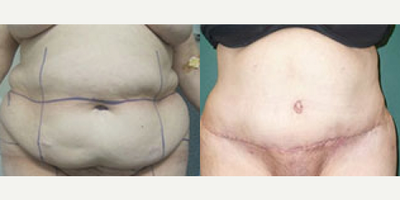 Body Lift before and after photo