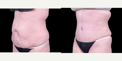 Tummy Tuck before and after photo