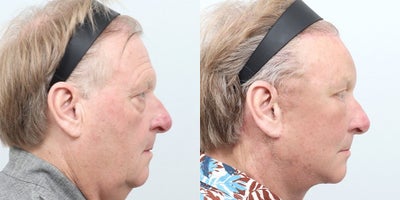 Deep Plane Facelift before and after photo