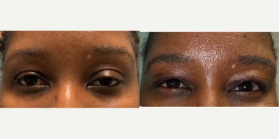 Eyelid Surgery before and after photo