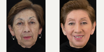 Facelift before and after photo